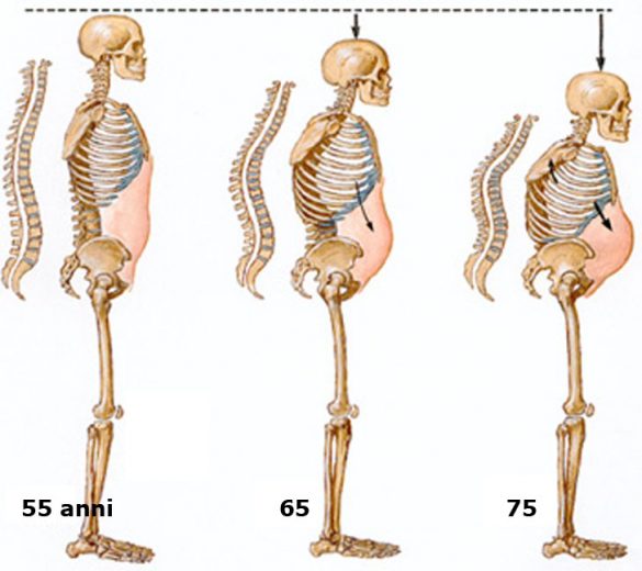 Salute Allarme Osteoporosi Pandemia Silenziosa A Rischio Oltre L