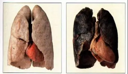 polmoni dopo 10 anni di fumo