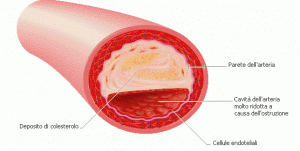 ARTERIOSCLEROSI 2