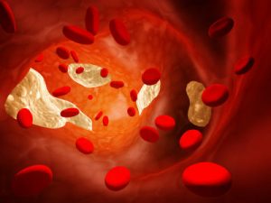 Atherosclerosis - clogged artery and erythrocytes