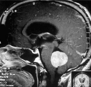 medulloblastoma