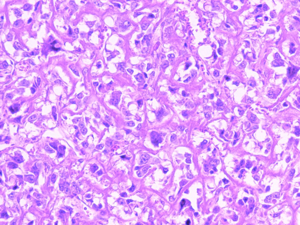 sarcoma