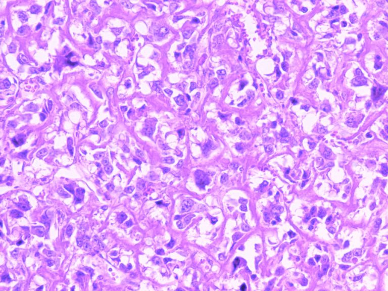 sarcoma