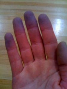 raynauds_syndrome_1