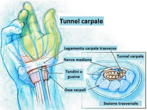 TUNNEL CARPALE