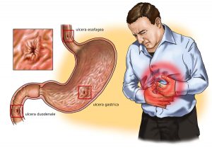ULCERA GASTRICA 1