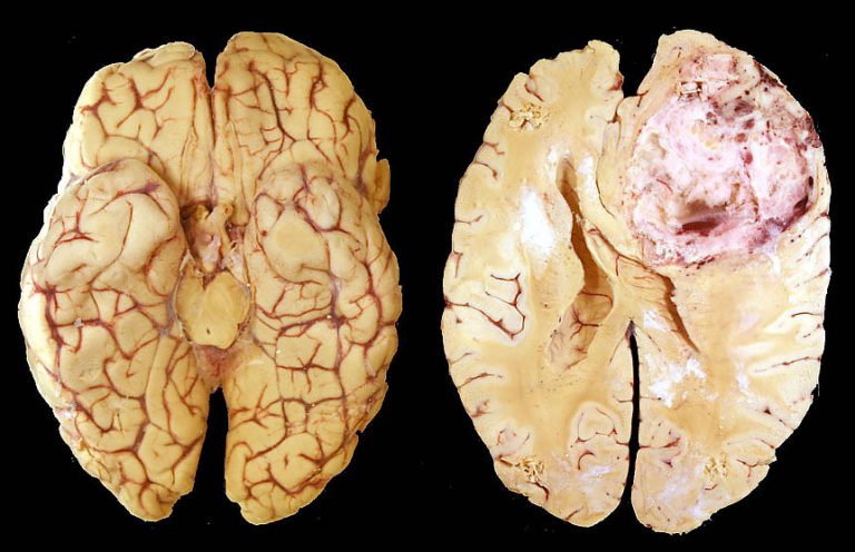 tumore sistema nervoso centrale Glioblastoma