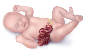 gastroschisi