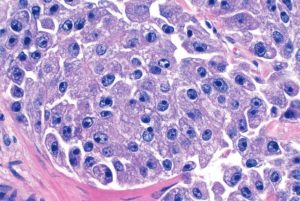 carcinoma-tumori metastasi