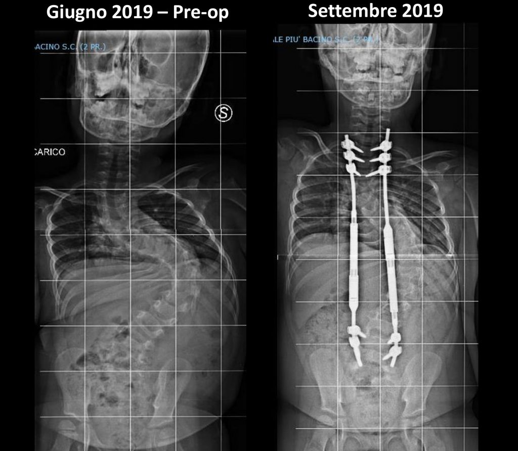 radiografia scoliosi intervento bambino gesù