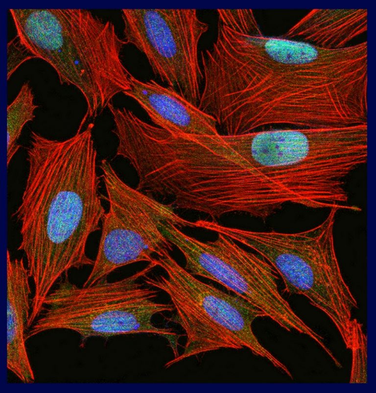 Cellule di osteosarcoma acquisite al microscopio confocale Bambino Gesù