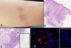 coronavirus