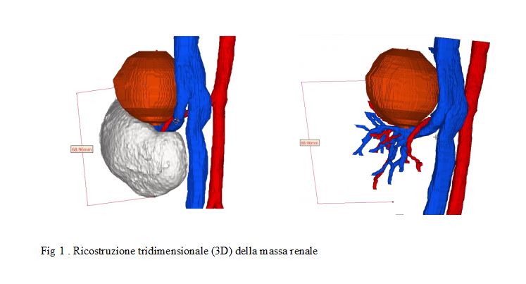 3D massa renale