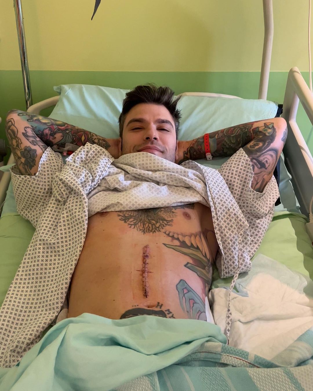 fedez tumore pancreas