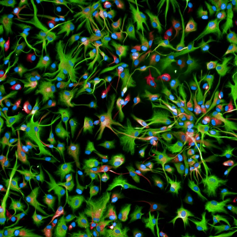 Cellule tumorali - Glioma Diffuso della Linea Median