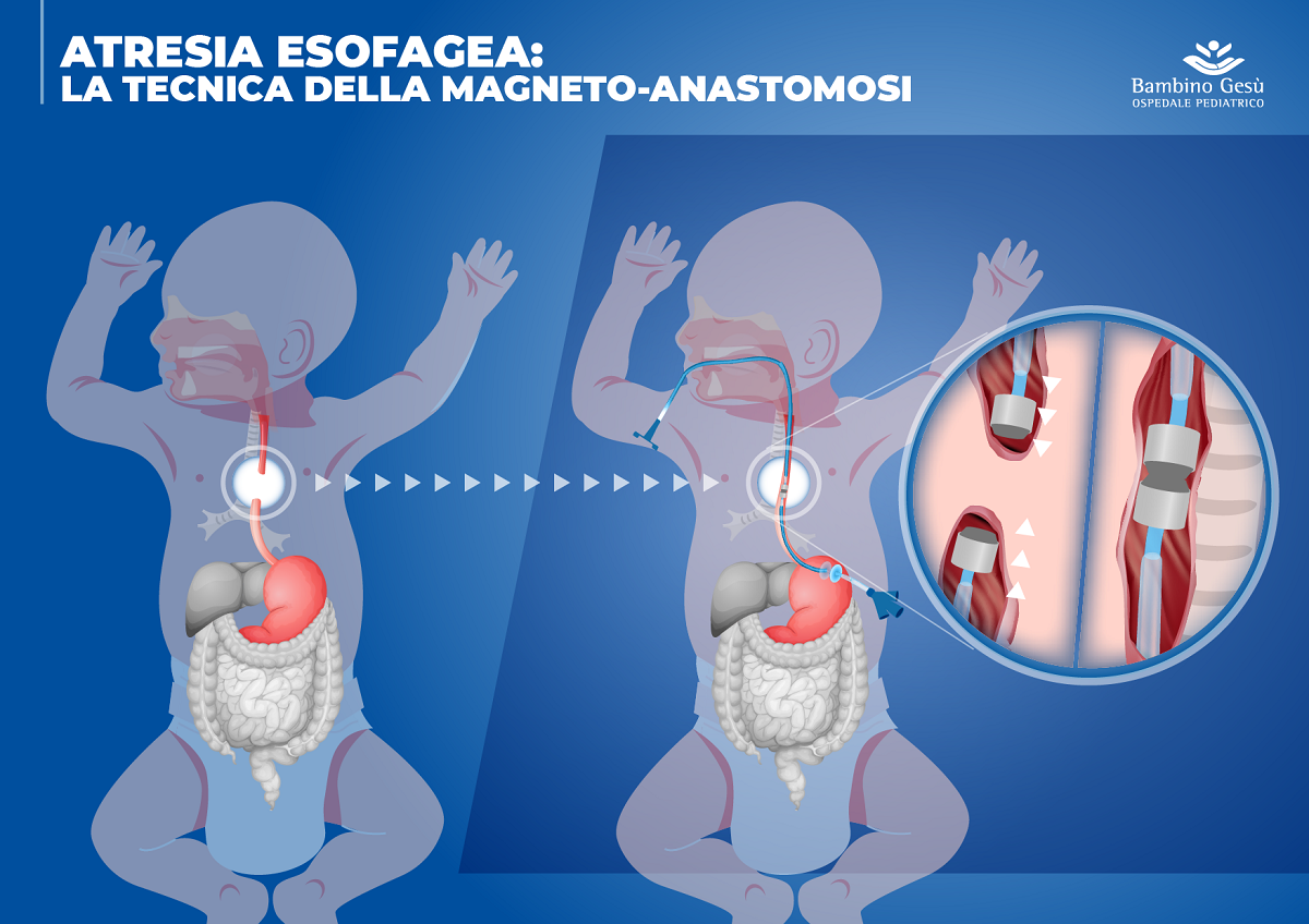 Atresia esofagea