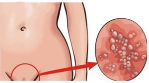 Human Papilloma Virus vaccino hpv