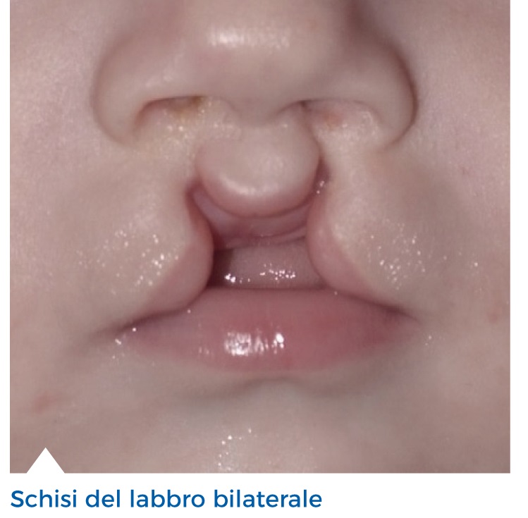 Labiopalatoschisi