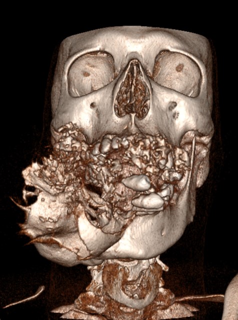 ameloblastoma Angelo Coga intervento